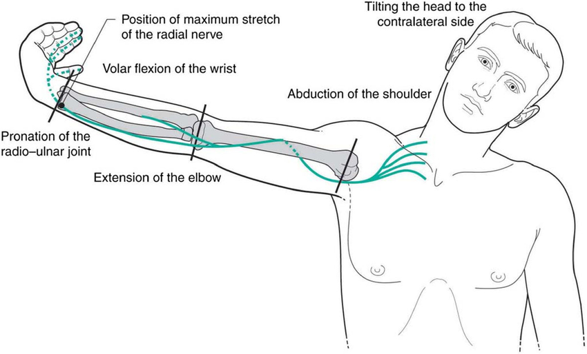 RNT as first represented by Von Lanz and Wachsmuth6. Note the similarity between Mills manipulation pre-manipulative stretch and this maneuver. From: Shacklock 5, Clinical Neurodynamics, Elsevier, with permission, after Von Lanz and Wachsmuth 6, Praktische Anatomie, Springer Verlag, Berlin. (iii) Radial neurodynamic test (von Lanz T and Wachsmuth W 1959 Praktische Anatomie, Springer-Verlag, Berlin, p. 47, with permission).