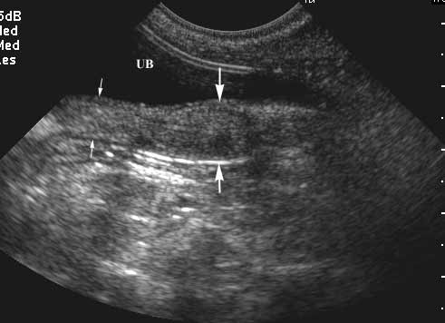 Uterine body and cervix dorsal to bladder