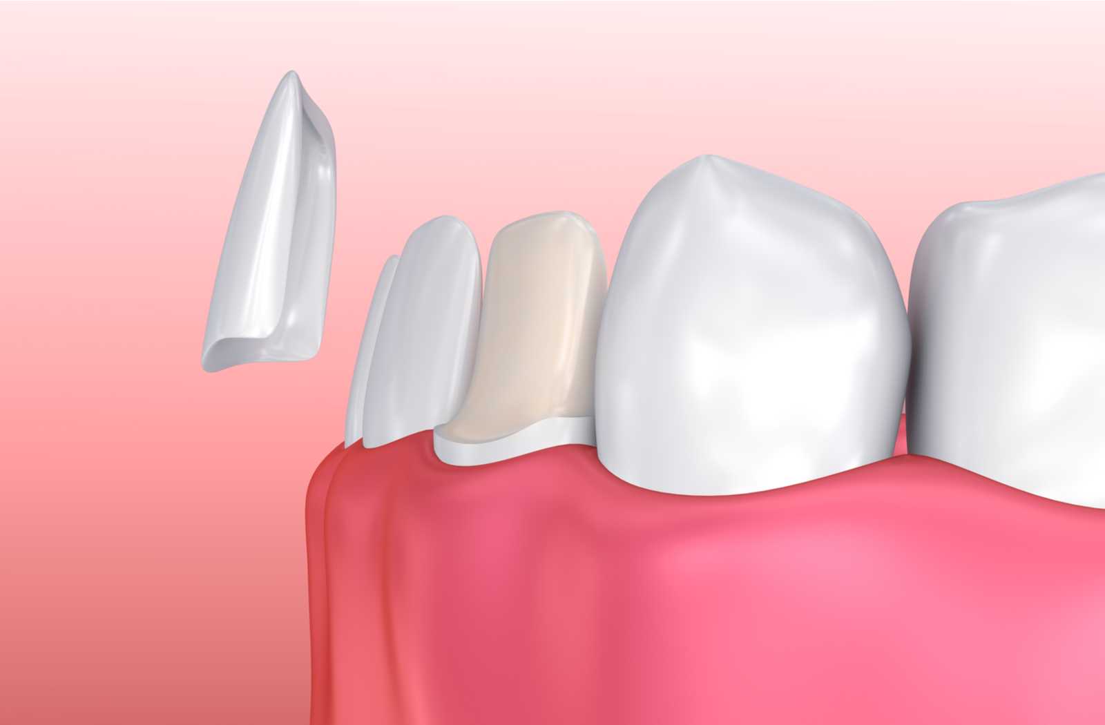 digital illustration of how a veneer fits with shaved enamel on pink gradient background