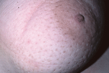Breast cancer in images