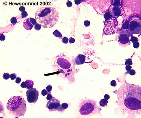 BAL cytology showing apoptotic neutrophils (arrow) engulfed by alveolar macrophages. Wright-Giemsa stain. Magnification: 1000X.
