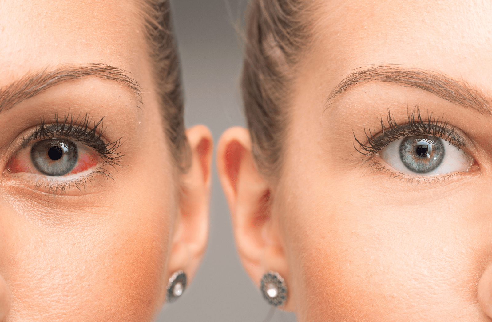 A comparison between a woman's healthy eye and a woman's red and dry eye