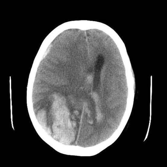  Imagem de uma TC de crânio sem contraste na qual é possível perceber um sangramento ("mancha branca") de localização lobar à direita. Possivelmente se trata de um paciente idoso com angiopatia amiloide cerebral. 