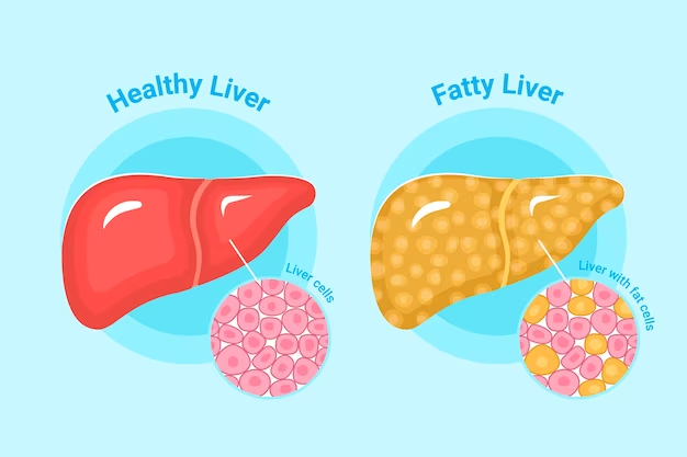 Liver Cyst And Fatty Liver ClinicSpots