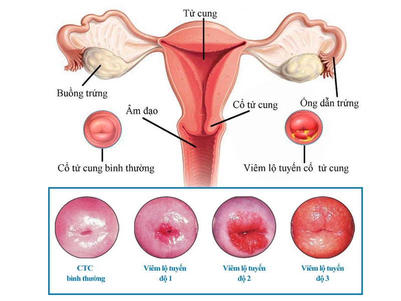 Bật mí cách xử lý bệnh viêm lộ tuyến bằng phương pháp Diện Chẩn