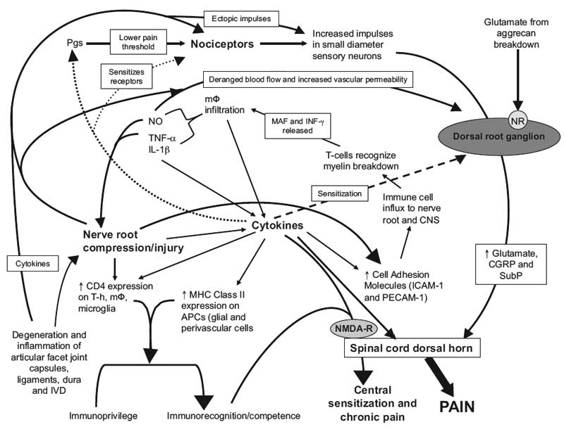 A schematic overview of the interplay of factors in acute and chronic radicular pain with nerve root compression