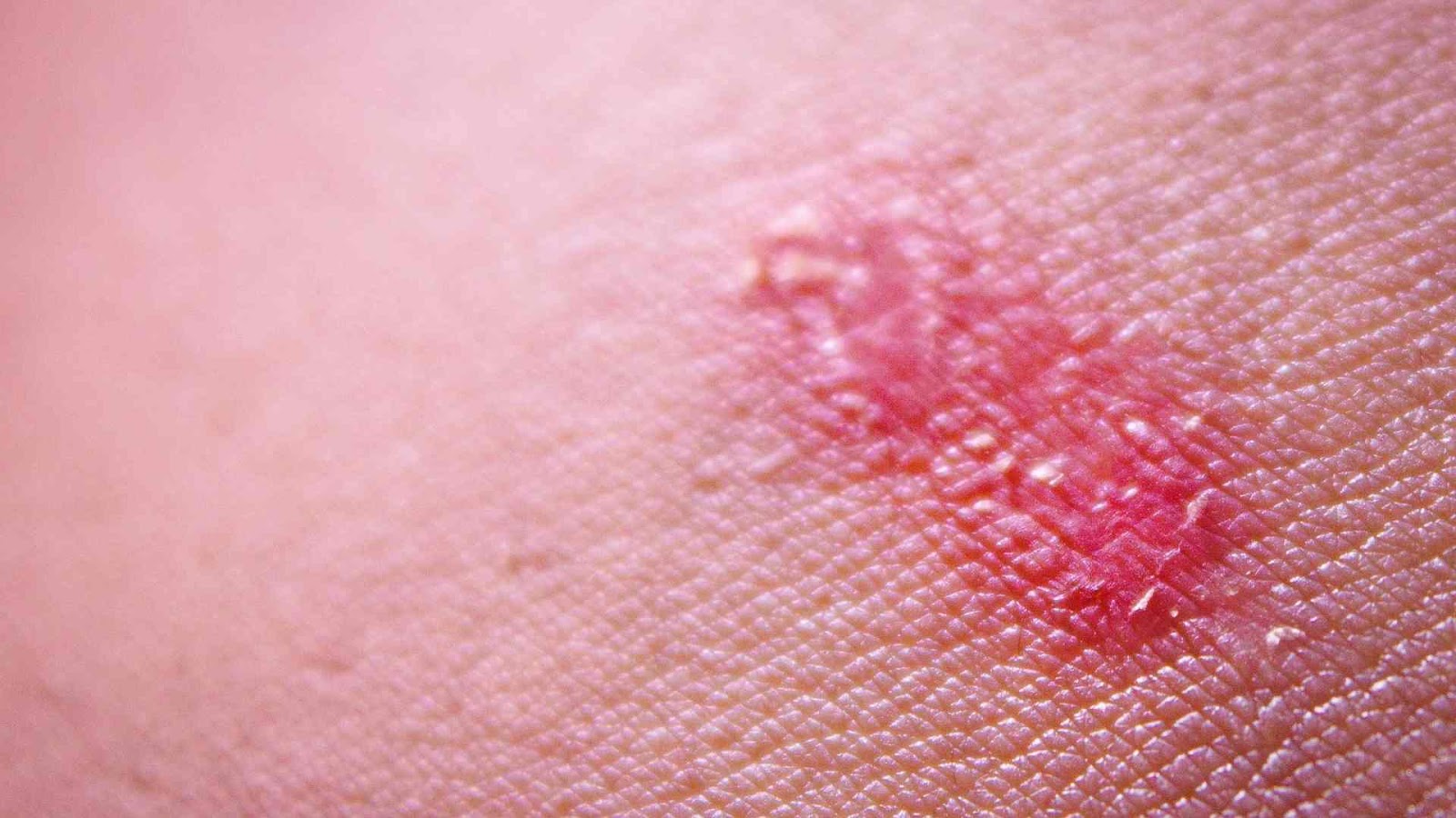 Skin infections can occur as a result of tearing or cuts exacerbated by thin skin caused by hydrocortisone and other topical steroids.