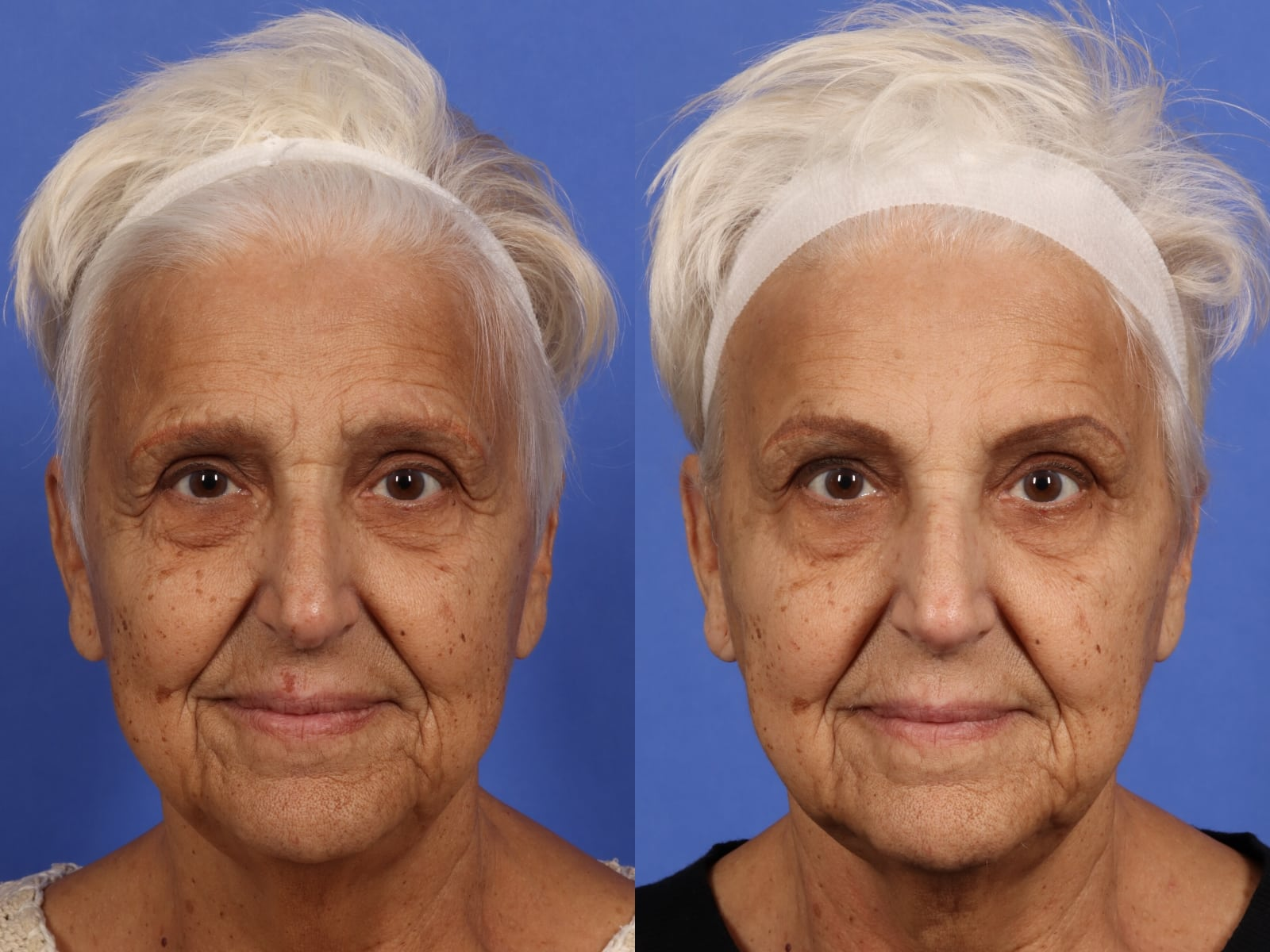 Picture showing a old woman who has used botox