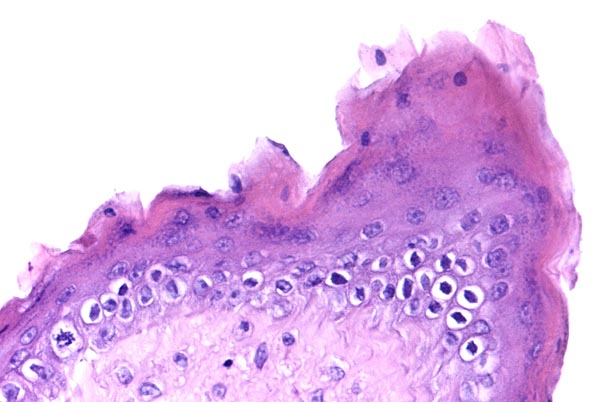 One of the areas of amnionic surface squamous metaplasia
