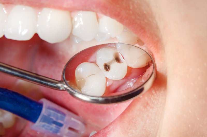 Sử dụng muối giúp giảm đau răng hiệu quả