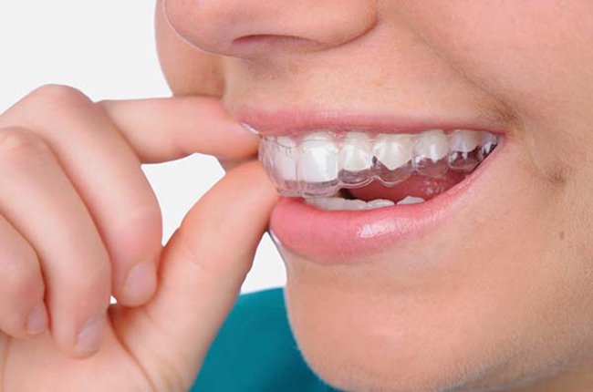 Máng chống nghiến răng cản trở sự tiếp xúc của hàm trên và hàm dưới