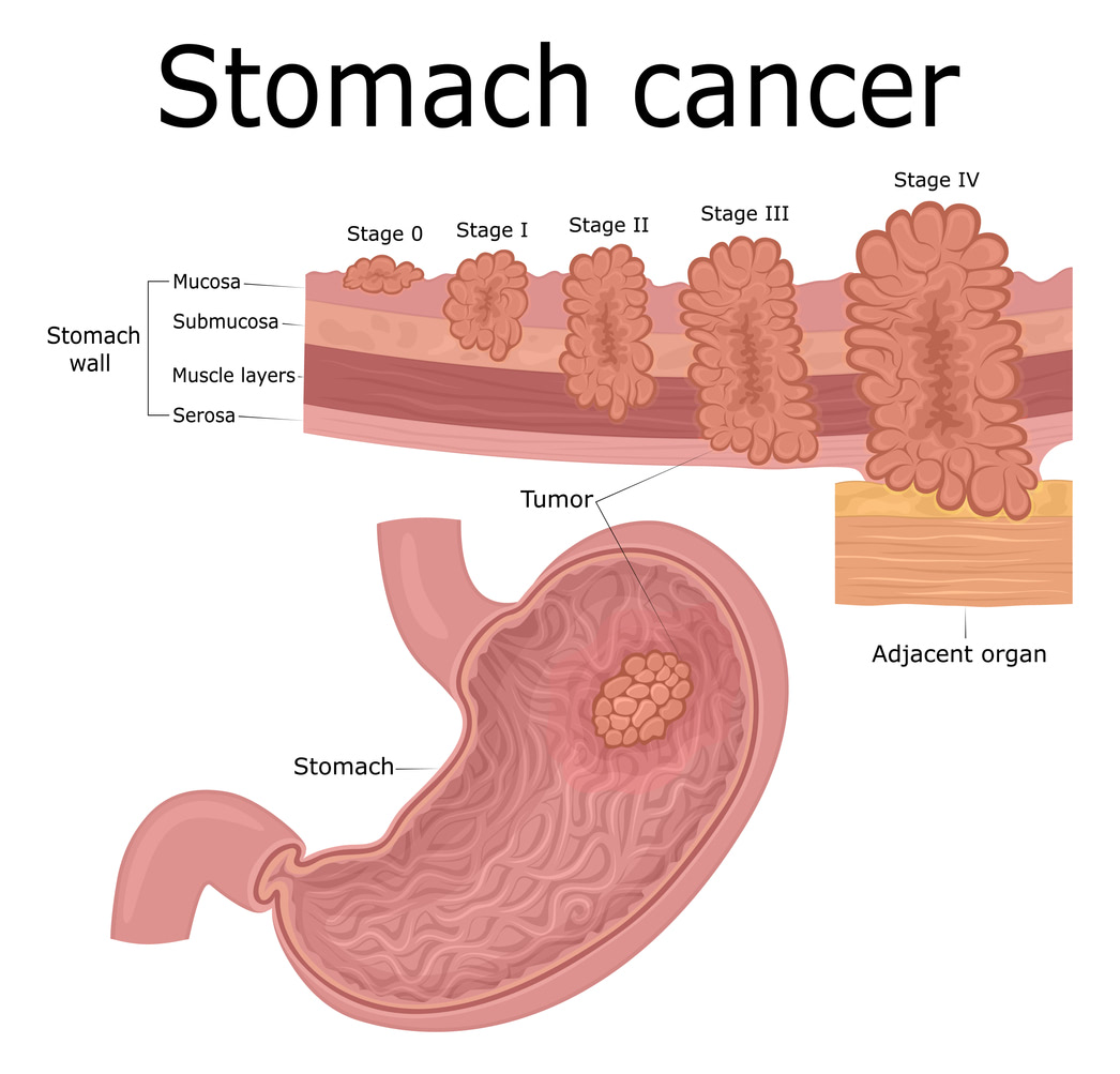 Stages of Stomach Cancer