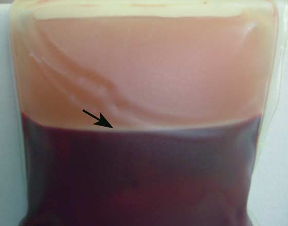 Sangre entera centrifugada con una capa de plaquetas