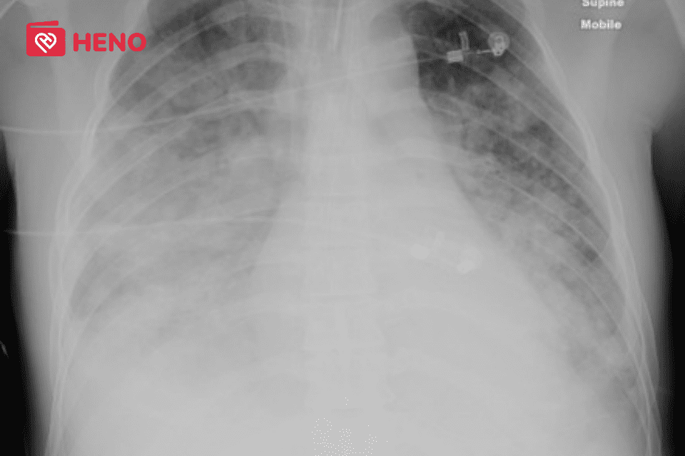 Hình ảnh chụp X-quang phổi của người bị khó thở, suy hô hấp hậu COVID