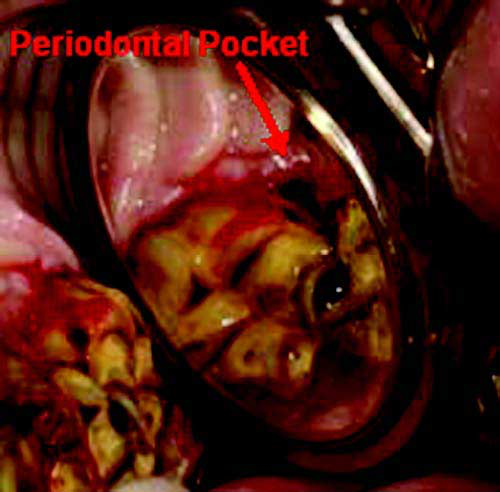 Periodontal pocket after subgingival scaling. 