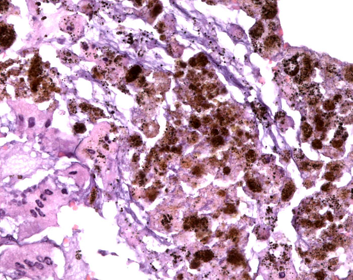 Surface of intestinal mucosa with numerous iron deposits in epithelium.