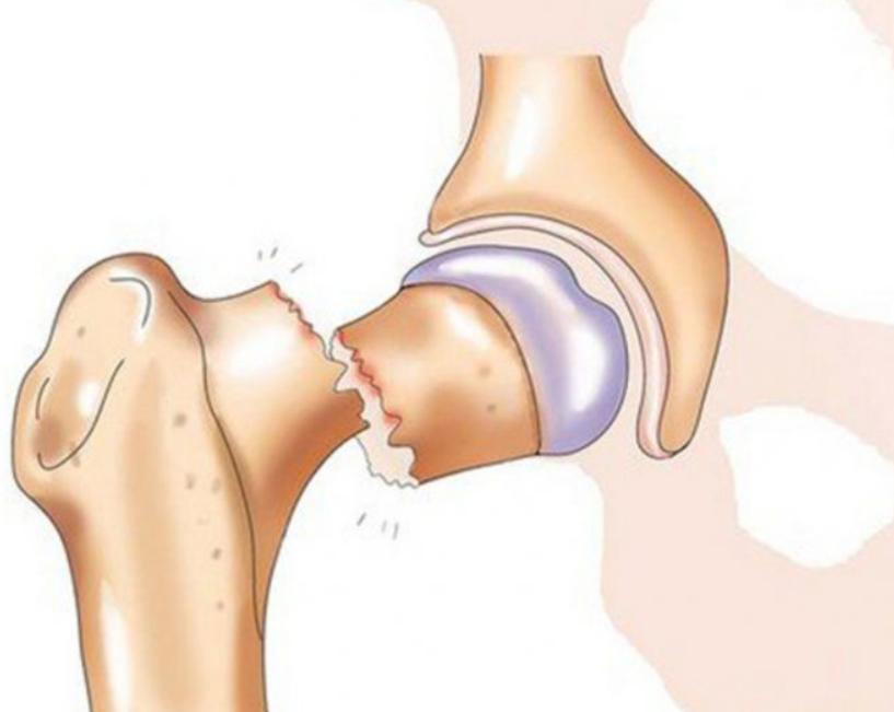 Трещина шейки. Тазобедренный сустав перелом шейки бедра. Открытый перелом шейки бедра. Вколоченный перелом тазобедренного сустава. Субтотальный перелом шейки бедра.
