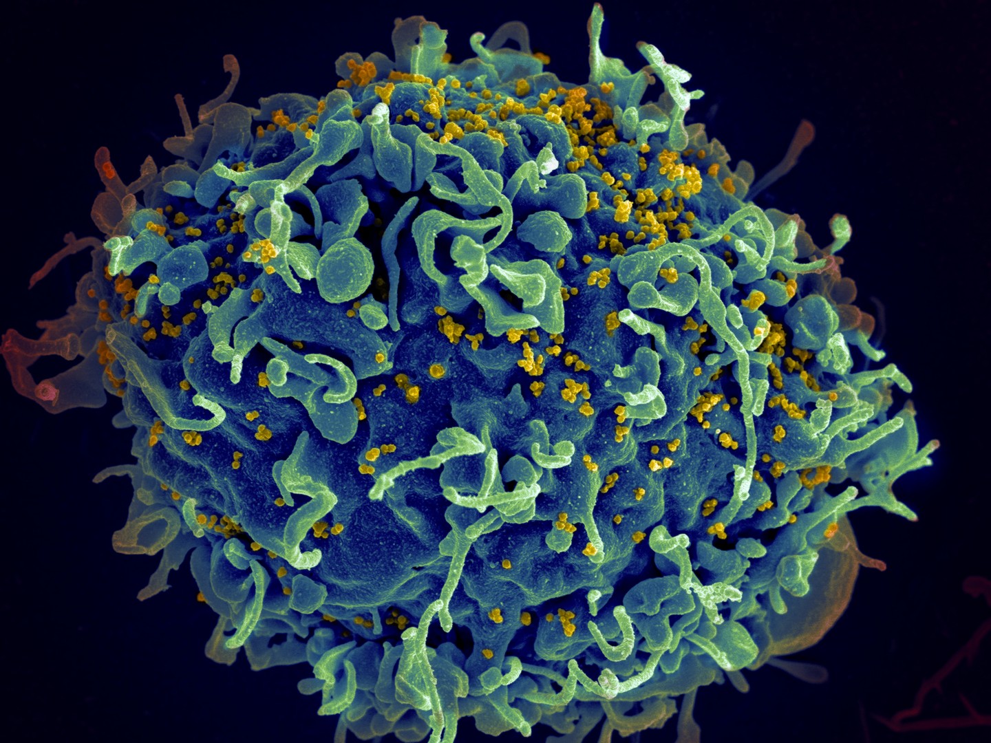 Representação do HIV (em amarelo) infectando uma célula T CD4+ humana