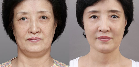 Phẫu thuật căng da mặt bao nhiêu tiền là thắc mắc của đại đa số khách hàng khi tìm đến Bệnh viện Thẩm mỹ Ngọc Phú