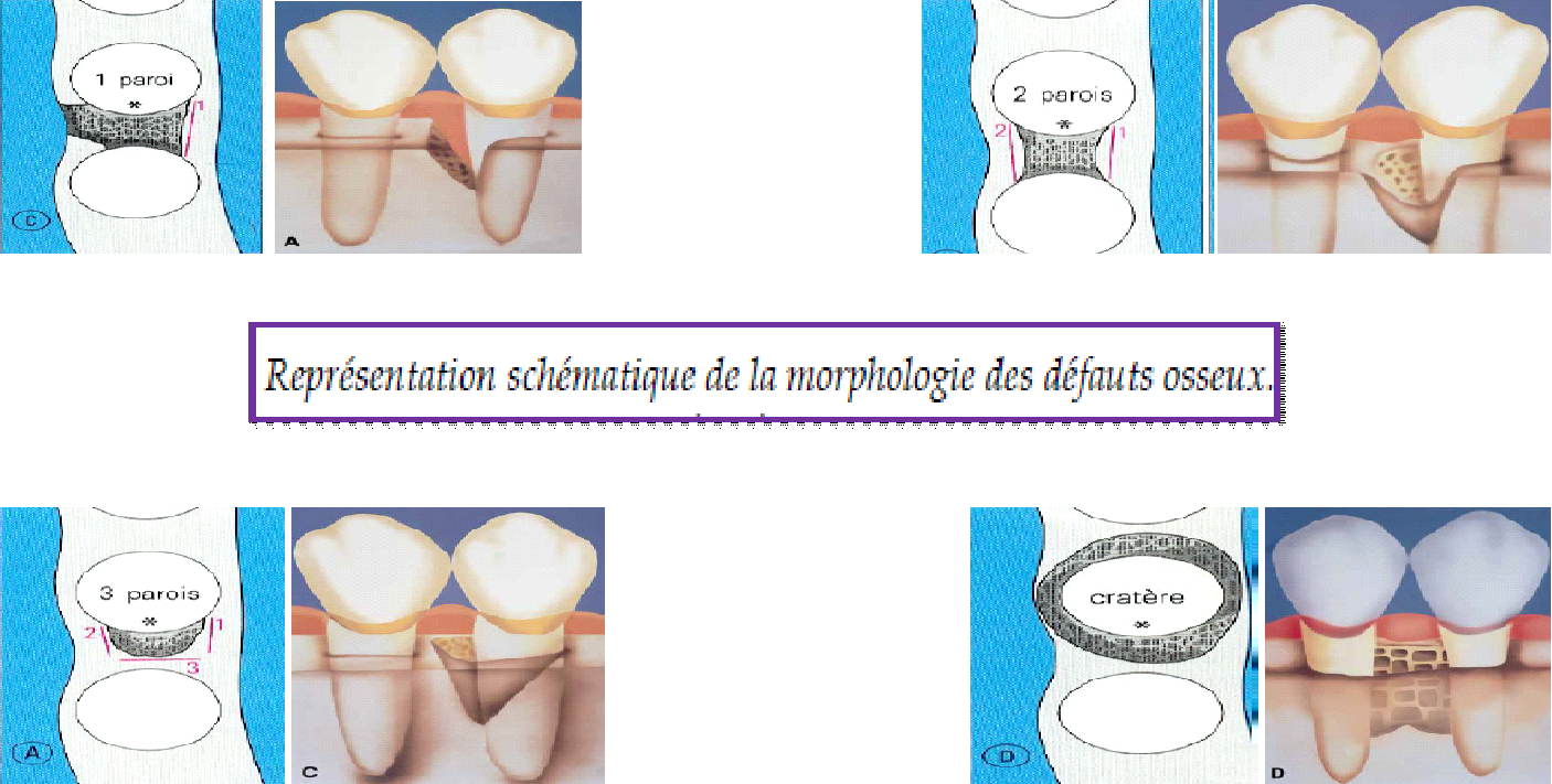 POCHE PARODONTALE