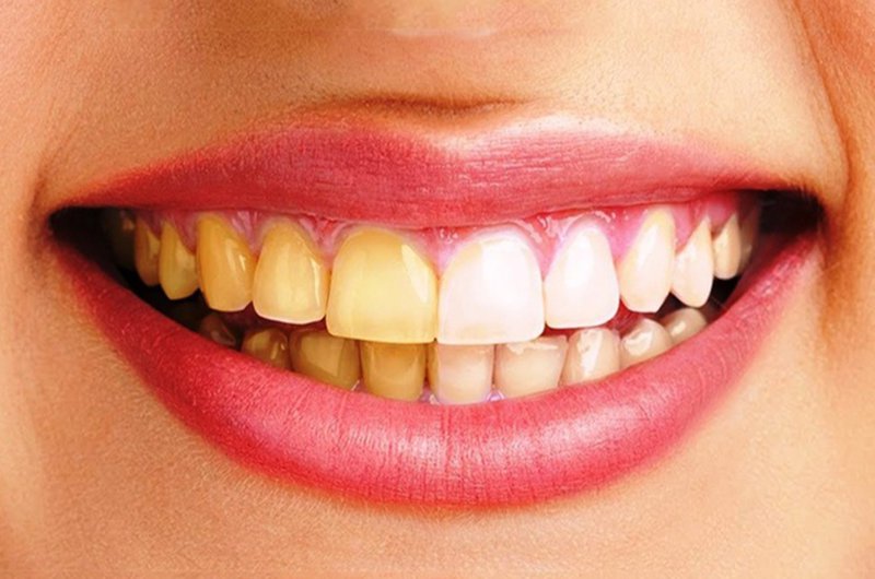 Nguyên nhân răng bị vàng, không trắng sáng