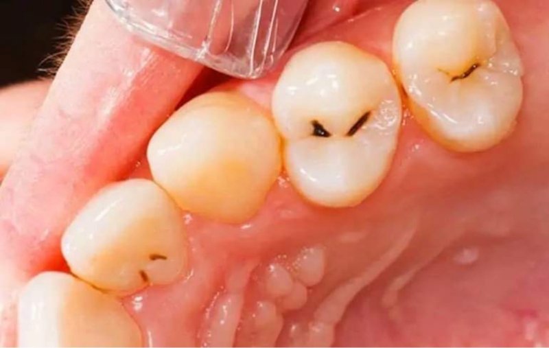 Răng sâu giai đoạn nhẹ có thể sử dụng phương pháp trám