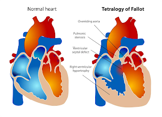 What is Tetralogy of Fallot (TOF)