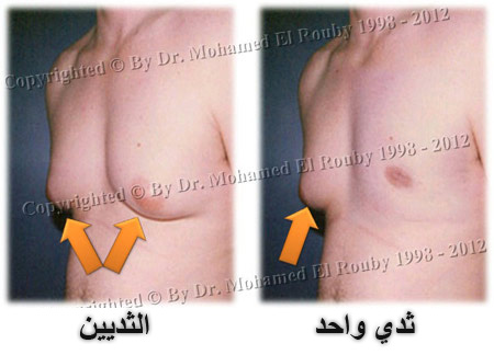 أنواع الجاينيكوماستيا أنواع الجاينيكوماستيا