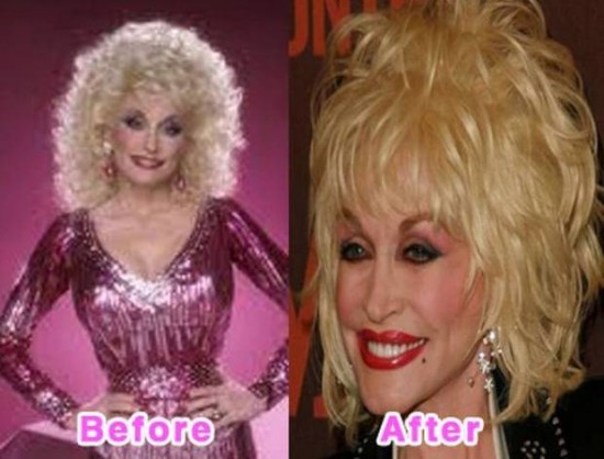 donatella versace plastic surgery before and after. Donatella Versace