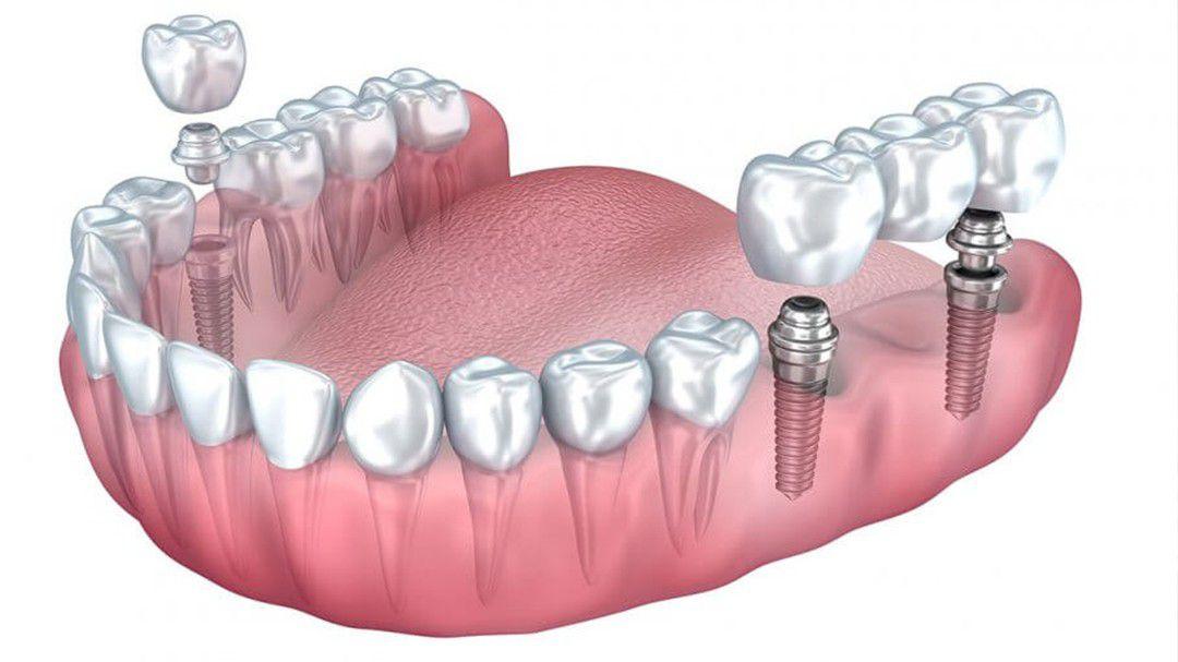 affordable dental implant center in Vancouver