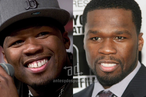 50 Cents y sus nuevos dientes, antes y despues