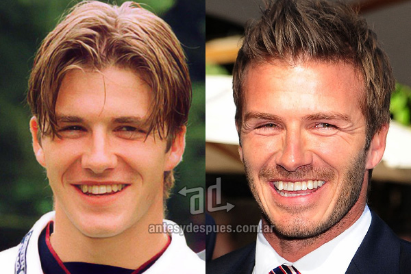 The new smile of David Beckham, afterdental surgery