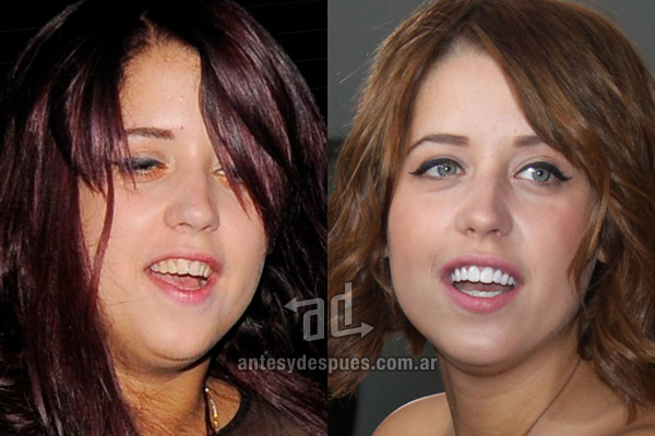The new smile of Peaches Geldof, afterdental surgery