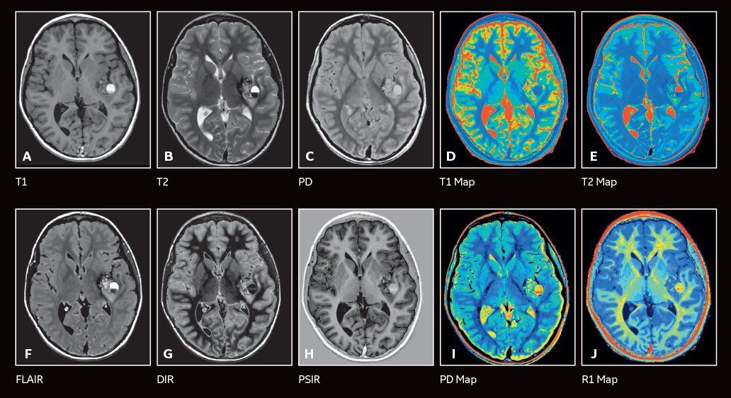 Hình ảnh của chụp cộng hưởng từ MRI não