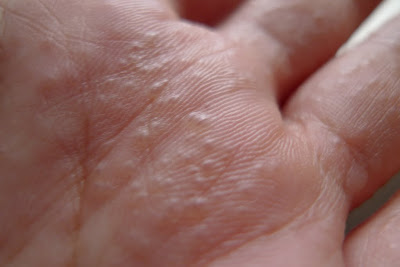 Scabies Rash On Hands