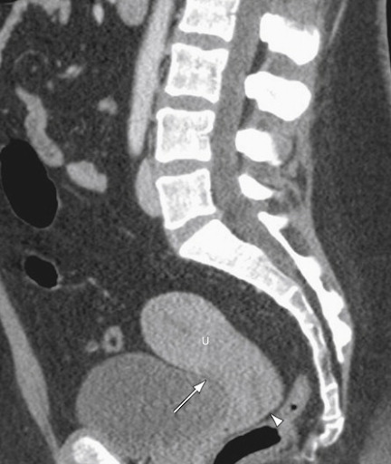 Aspecto tomográfico normal do útero (U). A seta maior mostra o recesso vesicouterino (reflexão peritoneal entre a bexiga e o útero) e a cabeça de seta mostra o fundo de saco de Douglas. 