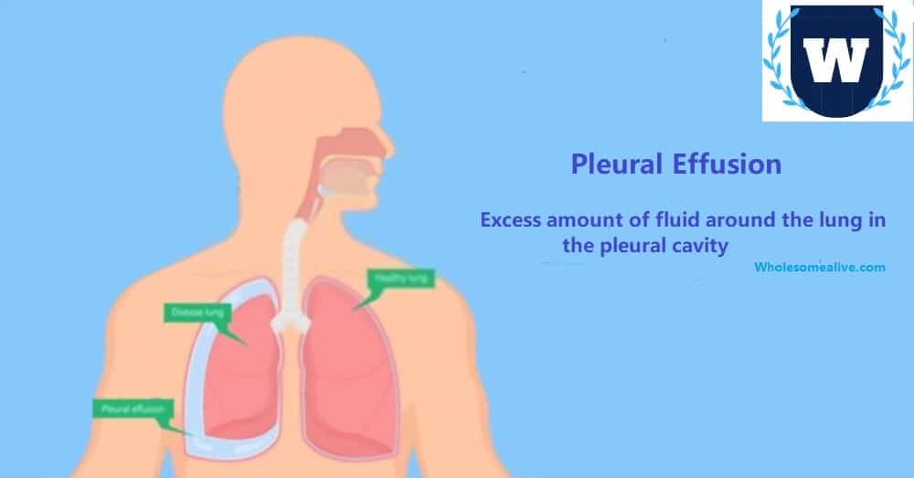 Pleural Effusion – Bubbling Sensation With Breathing Difficulty