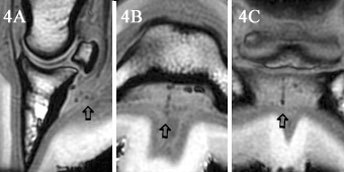 (A) Sagittal, (B) transverse, and (C) dorsal SPGR images of Case 3.
