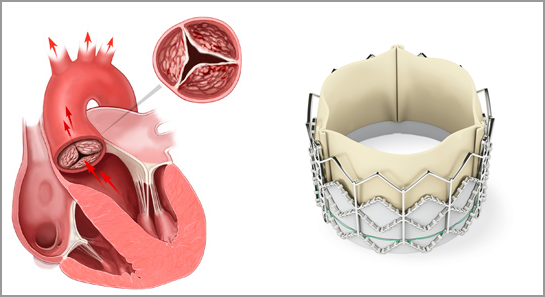 Transcatheter Aortic Valve Replacement (TAVR) | the Department of ...