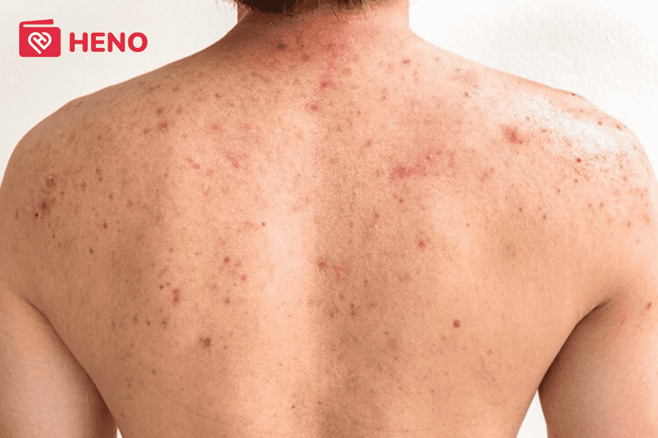 mụn lưng khiến nhiều người cảm thấy tự ti và tìm cách trị mụn lưng tại nhà nhanh chóng nhất