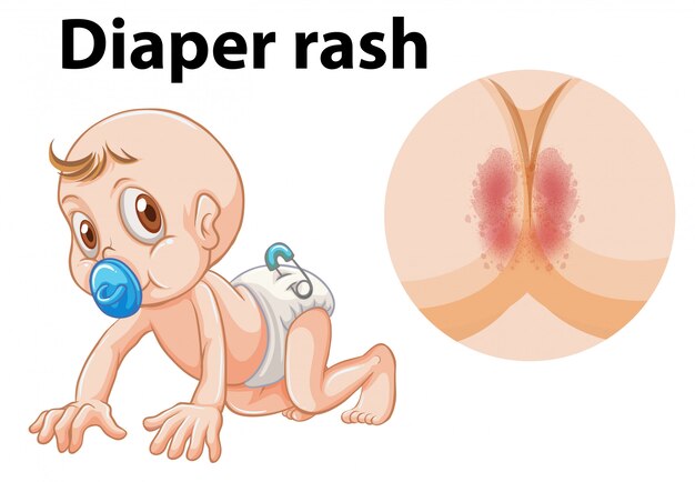 التهاب الحفاض( Diaper Rash)
