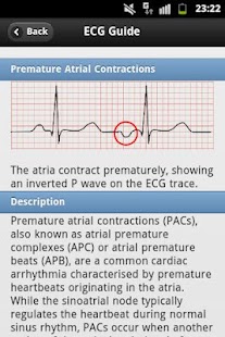 Download ECG Arrhythmias Pro apk