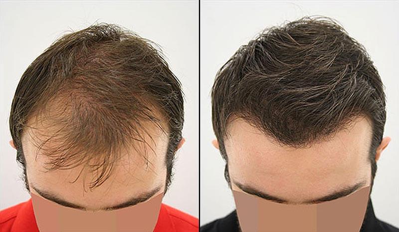 Hair Transplant – How Does It Work? What Do You Need To Know?