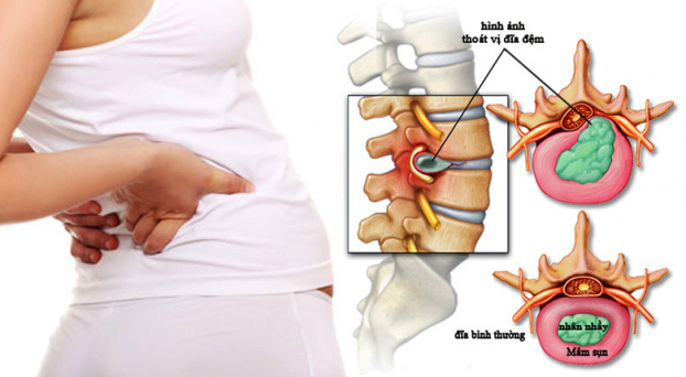 Bệnh Thoát Vị Đĩa Đệm: Nguyên Nhân, Triệu Chứng, Đối Tượng Dễ Mắc Và Cách Điều Trị Hiệu Quả