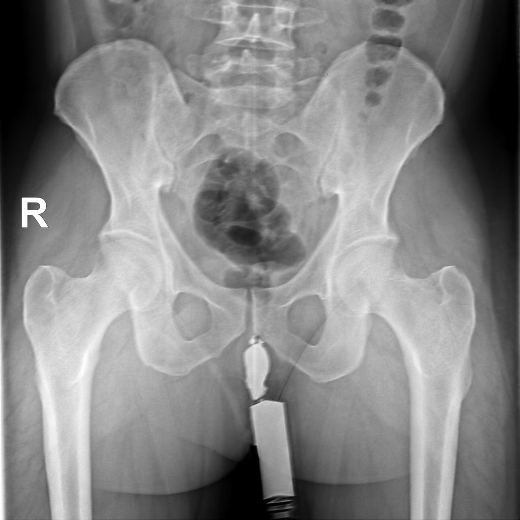 Perianal fistula: abscess | Radiology Case | Radiopaedia.org