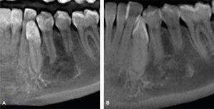 A. Radiografía preoperatoria de la lesión. B. Radiografía de control al año después de la cirugía, donde se observa formación de nuevo trabeculado óseo.