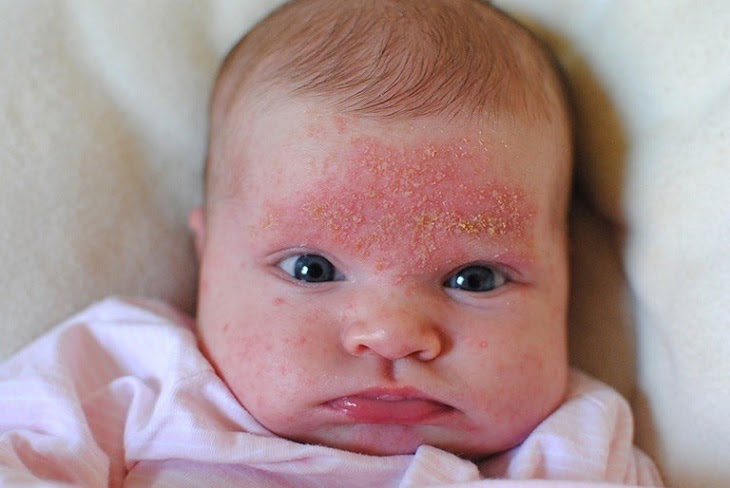 Hình ảnh viêm da tiết bã ở trẻ sơ sinh