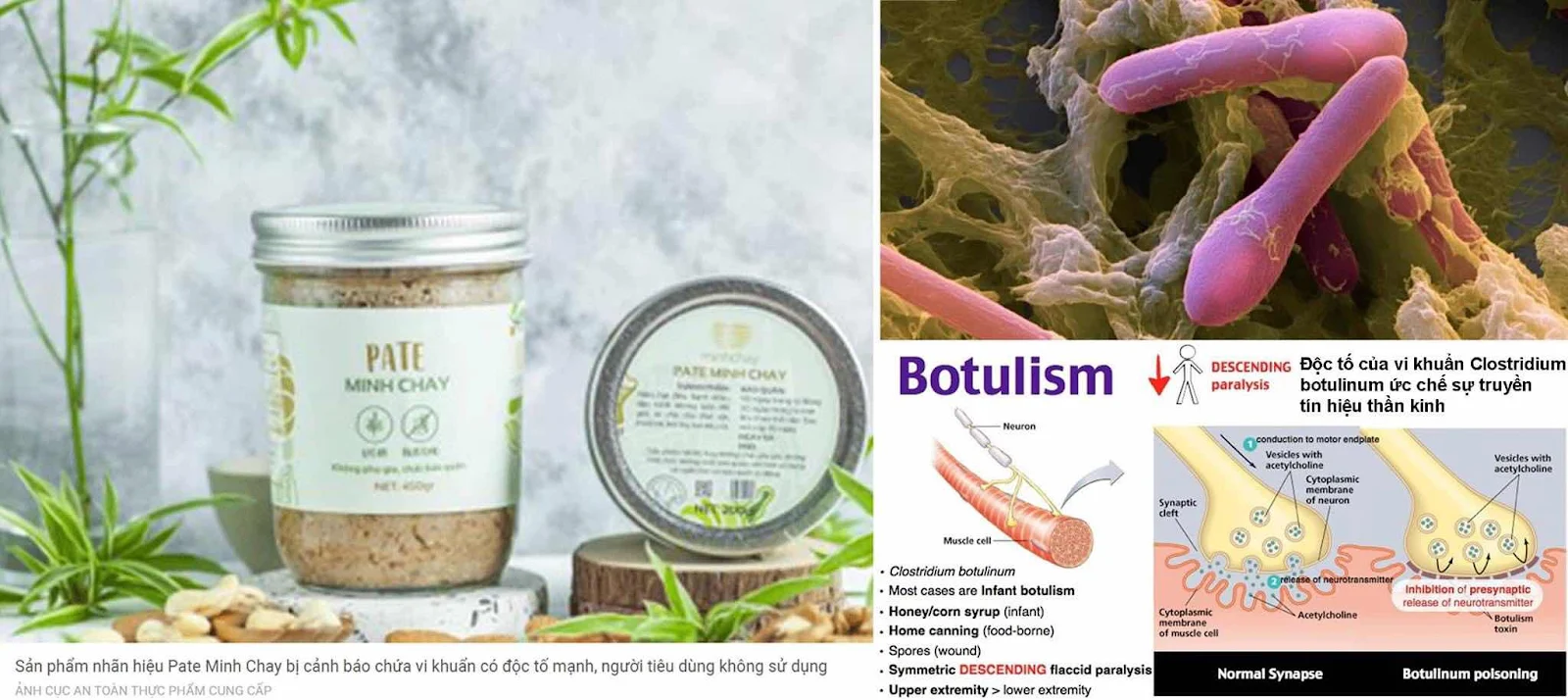 Ngộ độc thực phẩm do vi khuẩn Clostridium botulinum