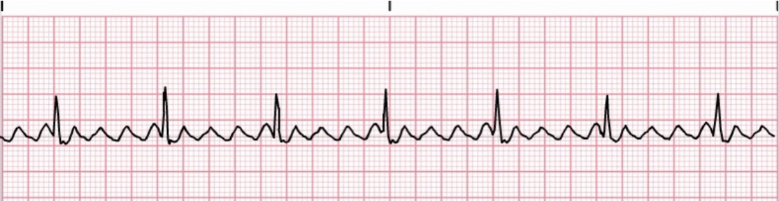 WHAT IS ATRIAL FLUTTER? | Club Afib