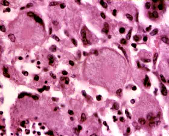 Detail of Figure 66, illustrating a similar tissue response as seen in Figure 65. However, Langhans giant cells in this case contained large numbers of acid-fast bacilli. Other causes for granulomatous pneumonias include foreign materials such as oil and silica dust, and mycotic or protozoal infections, particularly in foals.